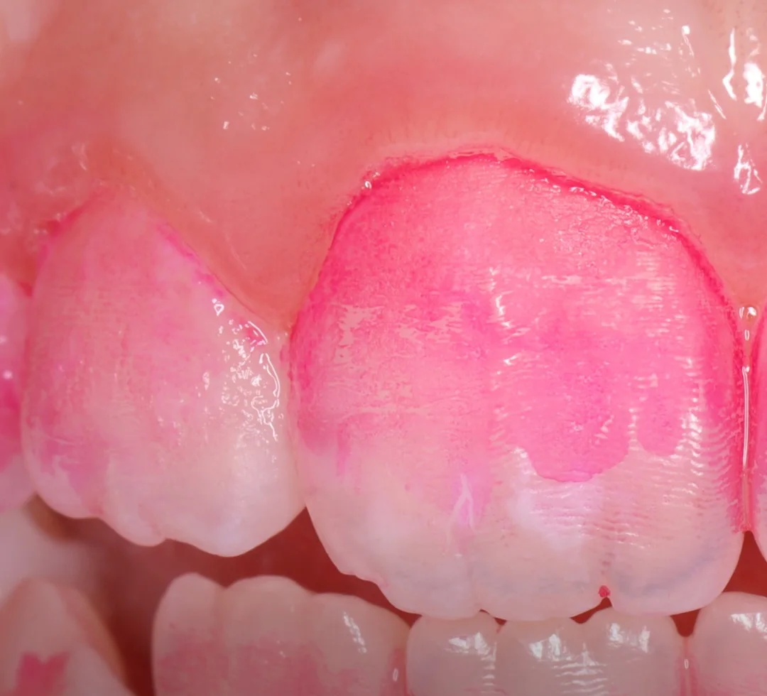 Dentes de leite da frente com áreas cor-de-rosa onde o evidenciador marcou o biofilme, perto da gengiva