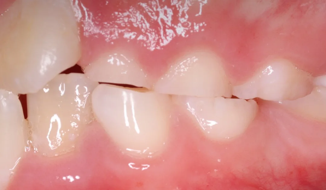 Dentes de criança vistos de lado, com as bordas desgastadas e retas pelo ranger