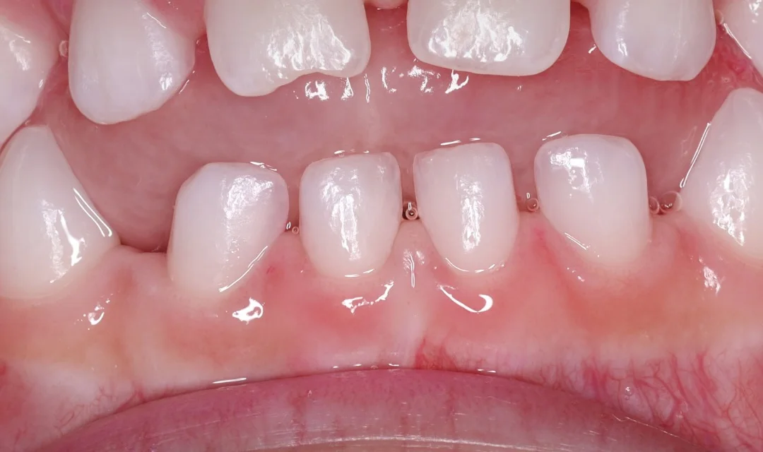 Dentes de leite de uma criança com um espaço entre os dentes de cima e os de baixo na frente: a mordida aberta