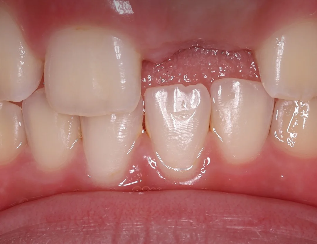 Dentes da frente de uma criança com um incisivo permanente já nascido e, ao lado, a gengiva ainda fechada onde o outro não nasceu