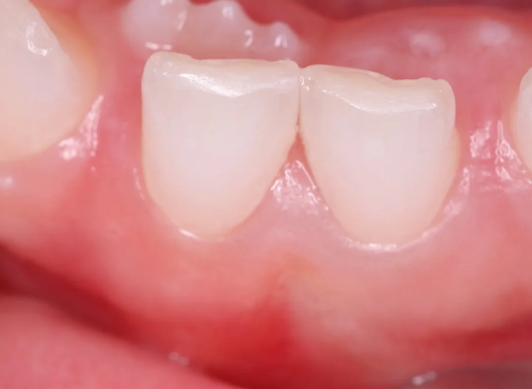 Arcada de baixo de uma criança: dois incisivos permanentes nascendo atrás da fileira dos dentes de leite
