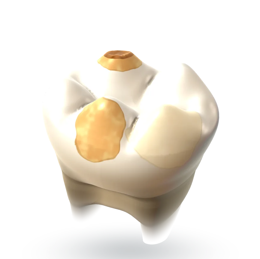 Modelo ilustrativo de um molar permanente com três manchas de HMI: uma creme, uma amarela e uma acastanhada no alto de uma cúspide